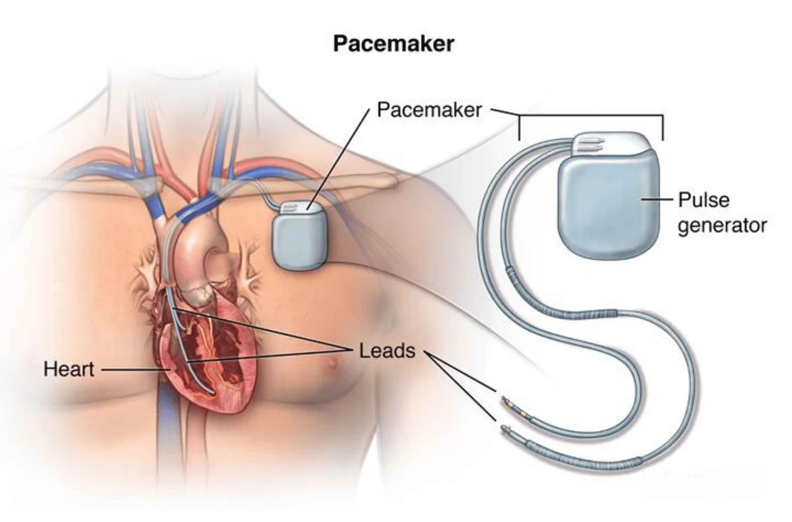 Pacemaker Implantation
